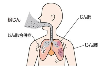 粉じんの有害性とじん肺