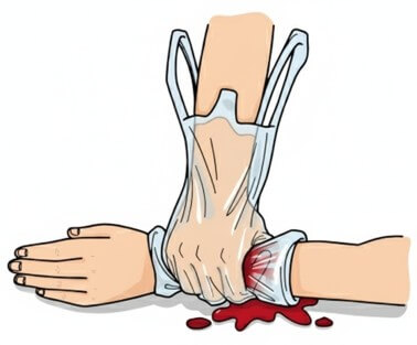 直接圧迫止血法