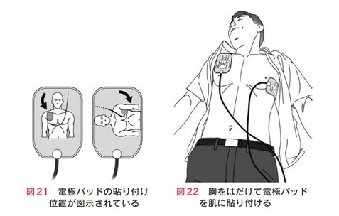 電極パッドを貼り付ける